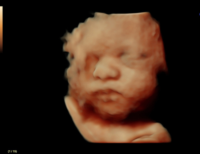3D ultrasound image at 31 weeks